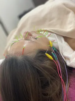 ご新規様限定◆美容鍼　(施術時間40分)　¥7,000→ ¥5,000