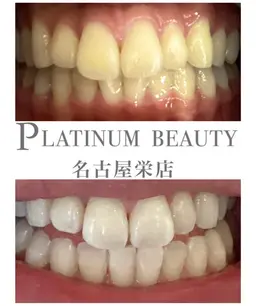 【当店オススメ！本気で白くしたい方へ】　プレミアムセルフホワイトニング✨〈2来店合計70分〉