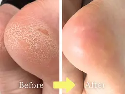 【フット】足裏角質ケア(タコ魚の目ケア)