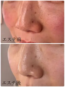 ミニモ限定！今だけ！【小顔へ、リンパを流す】フェイシャルエステ/エイジングケア＋無料鼻パック