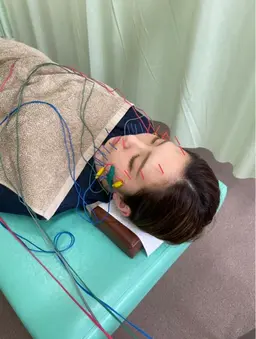 【今話題の美容鍼✨】美容鍼➕パルス電気鍼でむくみゼロのすっきり小顔に⭐️（カウンセリング込）