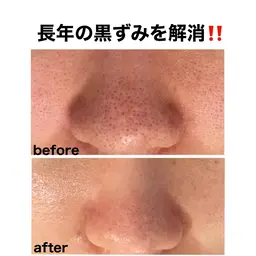 12月緊急企画❣️★頑固な毛穴の黒ずみ★毛穴の大掃除!根本改善で毛穴の悩みを解決したい方