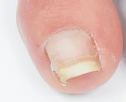 巻き爪改善テープ（爪を矯正し、痛みを緩和します）🦶✨