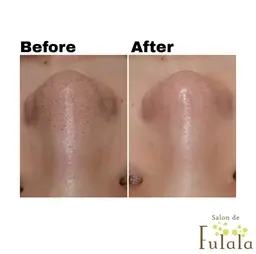 【ご新規様限定】毛穴の角栓ごっそり撃退コース ¥13,200→¥3,980