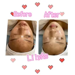 ［黒ずみ，乾燥肌］◎小鼻黒ずみ吸引×小顔コルギ60分　割引対象外