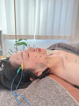 【鍼グリッター式】✨蘇らせ美容鍼✨️