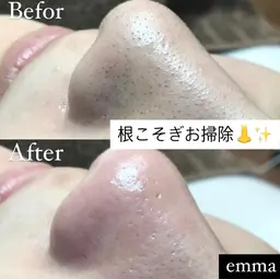 いちご鼻でお悩みの方！毛穴エクストラクション(デコルテオイルマッサージ・ヘッドマッサージ付) 90分