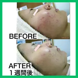 《ニキビ・ニキビ跡にも◎》✨エンビロンフェイシャルエステ2回体験5,930円✨　[大阪城北詰駅/京橋駅]