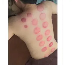 【体質改善】期間限定《肩・背中》カッピング＋15分流しマッサージ