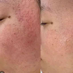 凸凹クレーターニキビ跡『マイクロチャネルでお肌蘇り✨自己修復力再生✨エステ史上最高の効果』