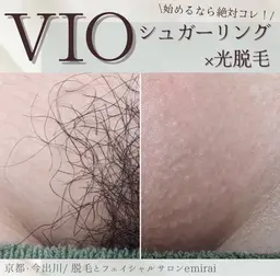 人気Ｎｏ.1✨シュガーリング🍯+最新式光脱毛✨で当日からつるつる！チクチクしないVIOmix脱毛🍯💕