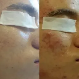 香里園/メンズフェイシャル/ビフォーアフター撮影モデル