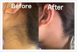 【ブライダル&イベント♪うなじスッキリ】美肌ワックス脱毛は毛根から脱毛するので、黒いブツブツが無く仕上がりがとても綺麗◎