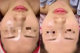 最新✨高周波美容【即効小顔】DTなしの感動を◎💆‍♀️