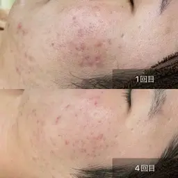 【繰り返しできるニキビにさよなら】ニキビでお悩みの方/ハーブピーリング🌿陶肌トリートメント