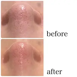 毎月10名様限定‼️【毛穴洗浄ハイドラ】新鮮な水素で洗浄と吸引で頑固な皮脂や角栓を一掃！