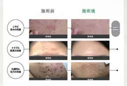 【60分】韓国式ハーブピーリング🌿40分¥7,920 ※マイルドな剥離あり