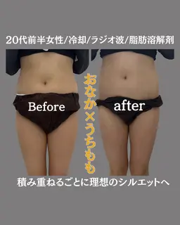 本気で痩せたいお腹【冷却ボディーケア4cup体験コース】 ダイエットサポートクリーム導入で即日効果実感！