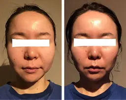 女性限定🌹小顔・フェイスライン 集中ケア