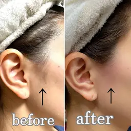 パーツwax(1パーツ)おでこ、もみあげ、鼻、鼻下、頬、あご(フェイスライン含む)