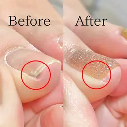 【巻き爪の方にオススメ】巻き爪ケア