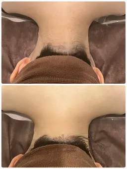 【1day完結】上半身ブライダルシェービングコース