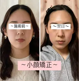 モニター様【圧倒的小顔美人へ】痛くない小顔矯正40分 小顔/エラ/歪み/むくみ/たるみ改善💎 ¥9500→¥6000
