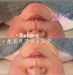 3月末まで限定【花粉で赤み・かゆみ出てる方専用】LDM× 抗体美容アドソーブ鎮静レスキュー60分