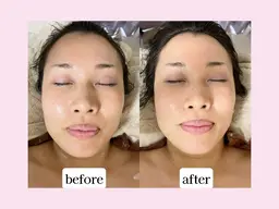 たった1回でフェイスラインスッキリ😍小顔フェイシャル💆‍♀️✨【夏限定🏖️】毛穴スッキリ炭酸パック付⭐️¥7700