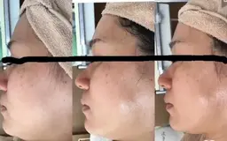 ジュエリースキンピール💎