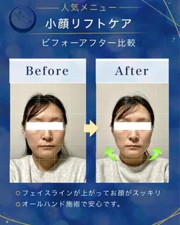 小顔リフトケア