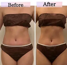 【お腹の内臓脂肪改善】デコルテ付き　ハイパーRE 40分