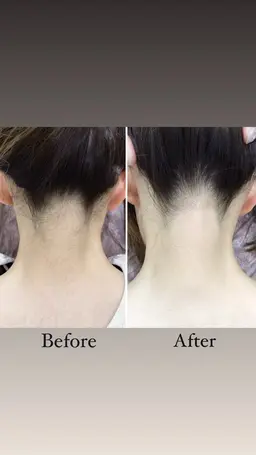 うなじ美肌脱毛💎