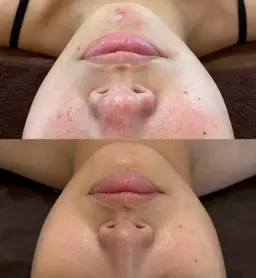 スペシャルプラン✨ハーブピーリング🌿