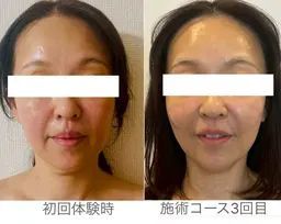 トライアングルフェイシャル3回コース