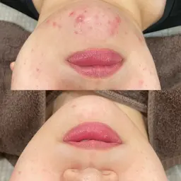 【平日のみ】背中剥離ありハーブピーリング🌿