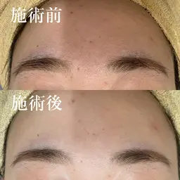 アイブロウ脱毛🐻💗丁寧なシェービング付きIPL脱毛✨回数やればずーっと美眉毛💕40年の脱毛実績で剃刀卒業🐻💗