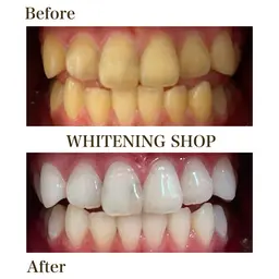 【静岡市ご勤務の方限定】当店初回セルフホワイトニング40分 8980円→1980円