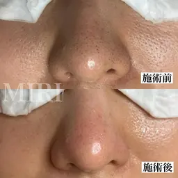 【29歳以下の方限定】いちご鼻バイバイ🍓ツルツル美肌になる毛穴ケア50分【ミニモ特別価格】カウンセリング込み80分