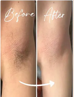 🩷SHR脱毛🩷全身（顔、VIO除）サクッと終わる人気メニュー✨🌱