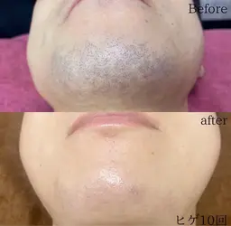【リニューアルオープン価格】　⭐️男性全顔脱毛（鼻下、口下、顎、顎下、首、もみあげ、両頬、おでこ）