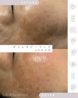 【短期間集中🌟高濃度炭酸美容液ガリレオピーリング】嬉しい！デコルテマッサージ付き❣️