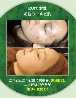 【毛穴・ニキビ🔥】剥離なしハーブピーリング＋毛穴洗浄or高濃度美容液導入エレクトロポレーション¥9,000