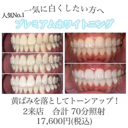 【人気No.１】プレミアムホワイトニング 2来店合計70分 輝く白い歯へ🦷✨