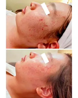 【初回☆赤いニキビ徹底ケア】ポツポツできにくい肌に！ ニキビ肌徹底ケアフェイシャル