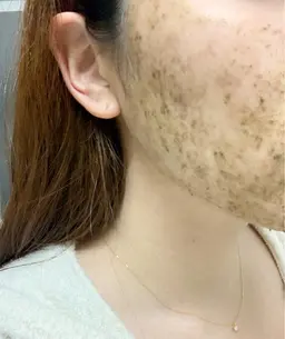 大人気！肌質改善✨ニキビケア‎🤍お肌のざらつき‎🤍つるつるお肌へ‎🤍天然ハーブピーリング￥7800🌿‬