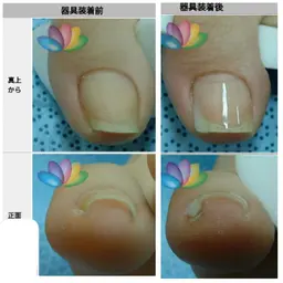 初回限定巻き爪補正【軽度】プリパレーション無料&爪の長さ整え無料サービス