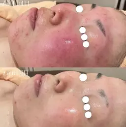 【当日🈹★】幹細胞エステLit🩷 たるみ/シミ/シワ/毛穴/ニキビ跡