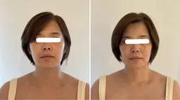 ハイパーナイフ小顔コルギ60分