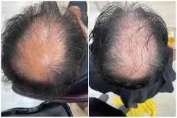 水素スパ🧖‍♀️間葉系幹細胞配合！！